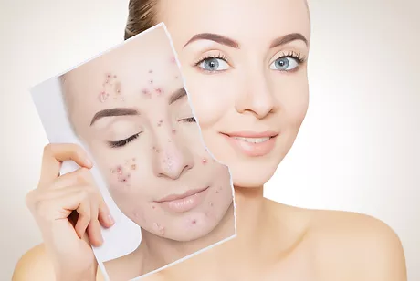 Ossigeno Ozono Terapia Acne