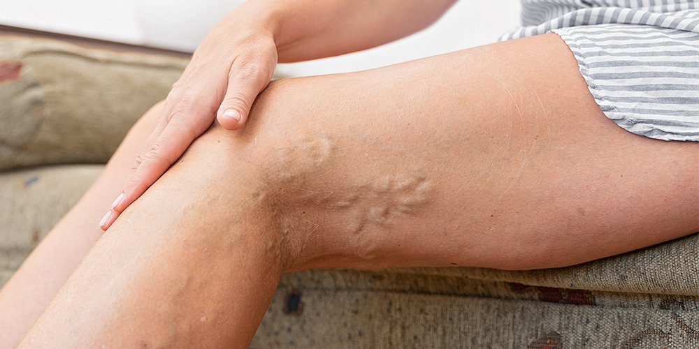 L'ESTATE E' FINITA, E' ORA DI OCCUPARCI DELLA SALUTE DELLE VENE DELLE GAMBE