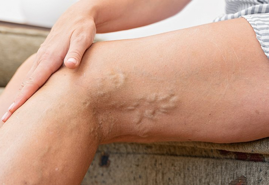 L'ESTATE E' FINITA, E' ORA DI OCCUPARCI DELLA SALUTE DELLE VENE DELLE GAMBE