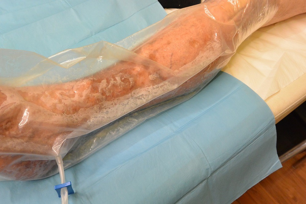 foto di ozonoterapia sacchetti Image